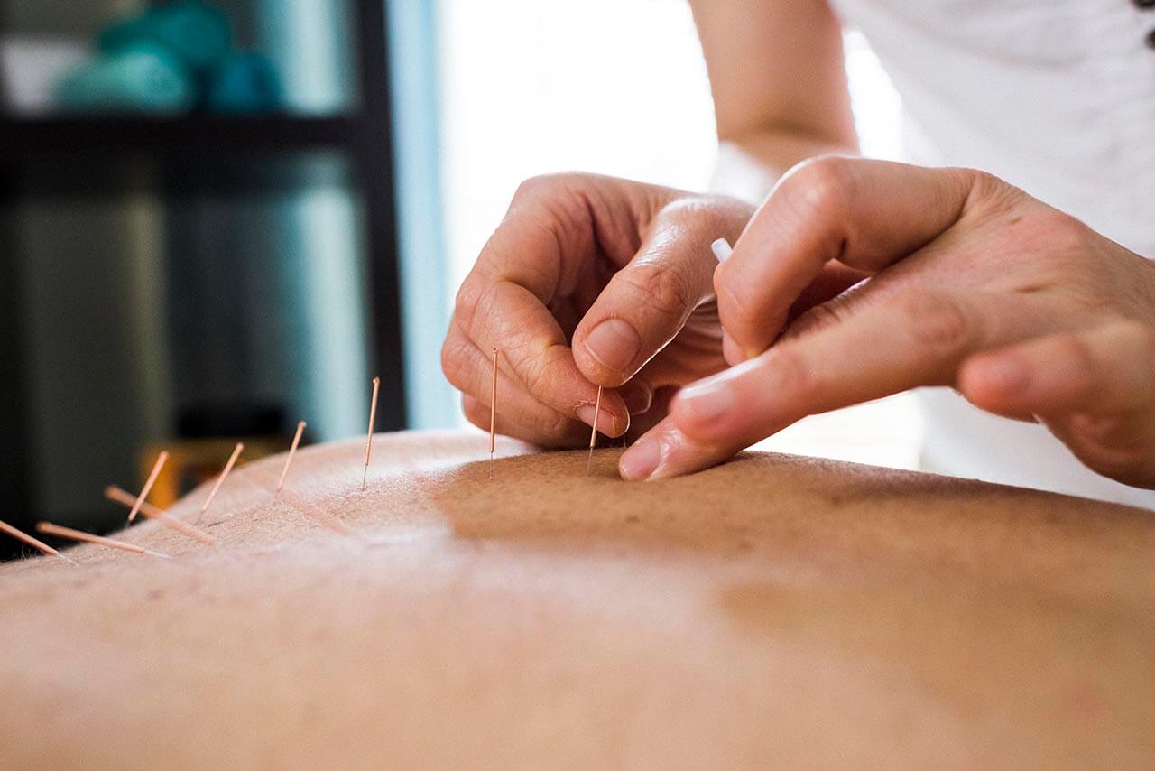 Acupuncture needles in skin